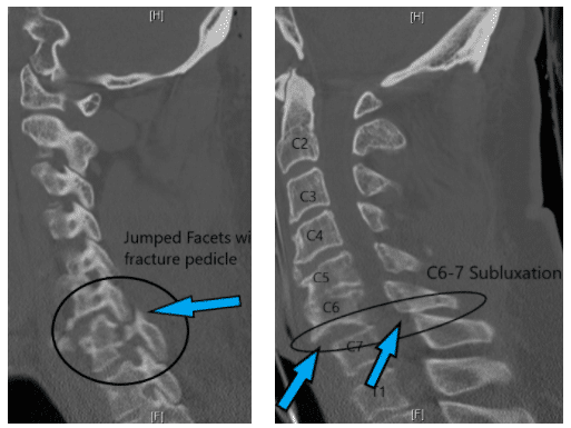 Left Hip Core Decompression with Stem Cell Injection in a 45 year-old male with Avascular Necrosis (AVN) of the Hip​