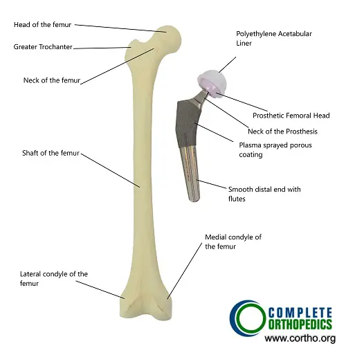 Hip Replacement Surgery